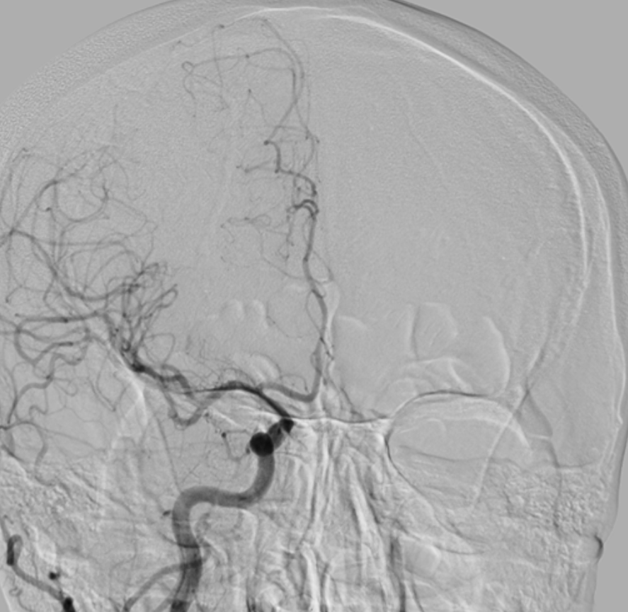 Carotid 2 MT