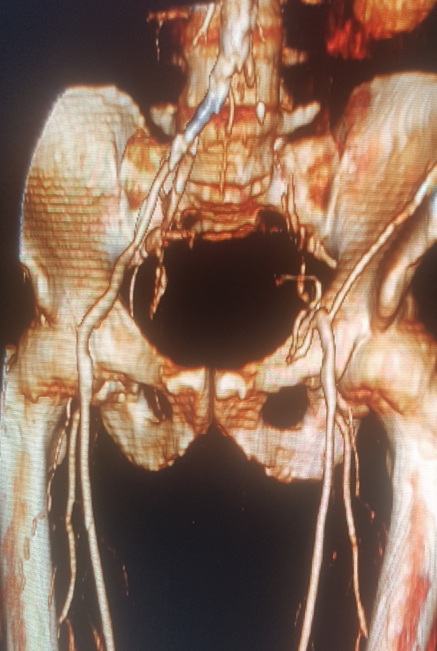 Iliaac Occlusion 1 KT 1