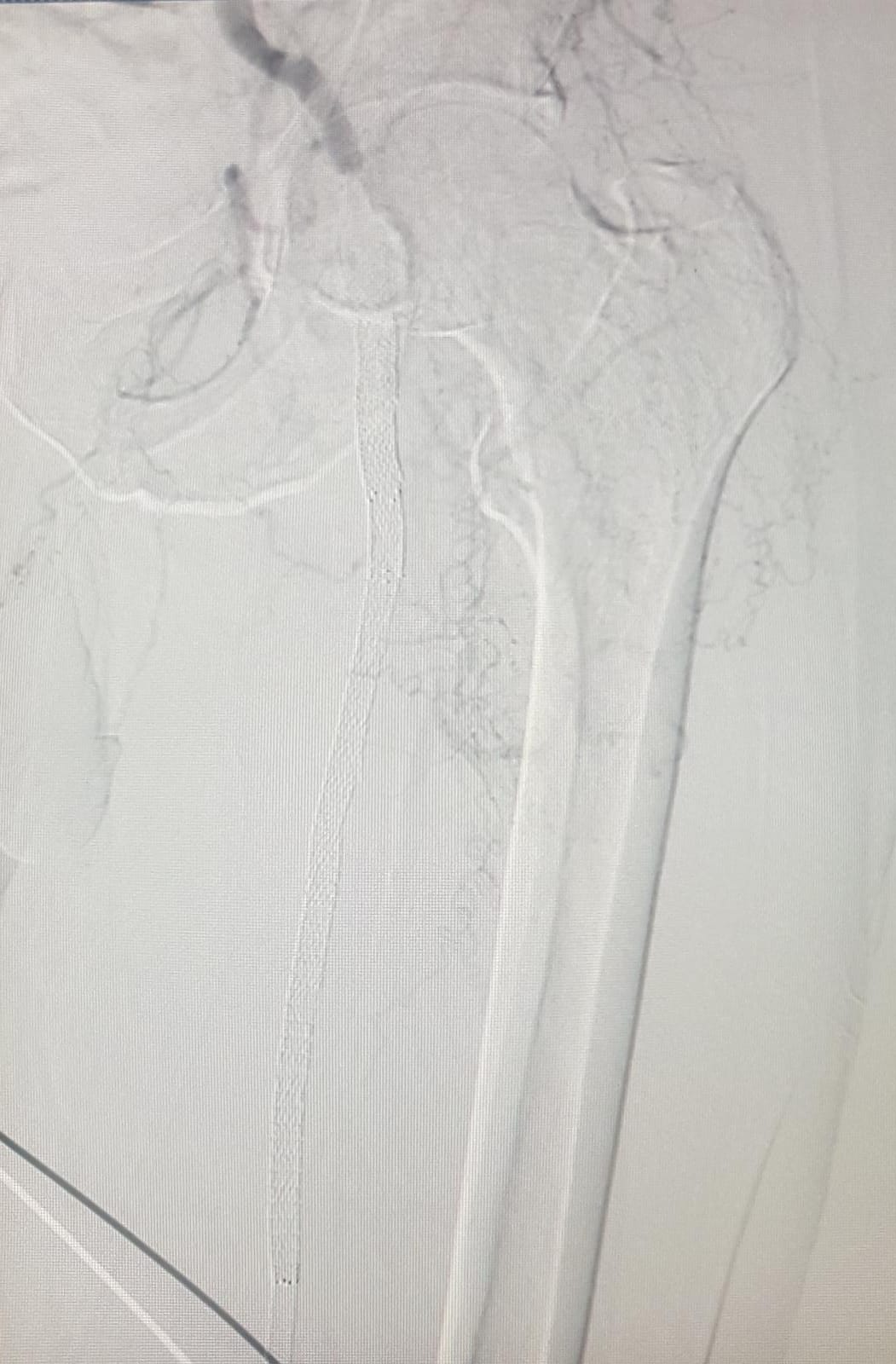 SFA Restenosis 1 MT