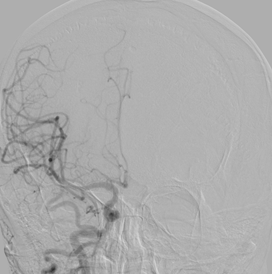 Carotid 3 SAK