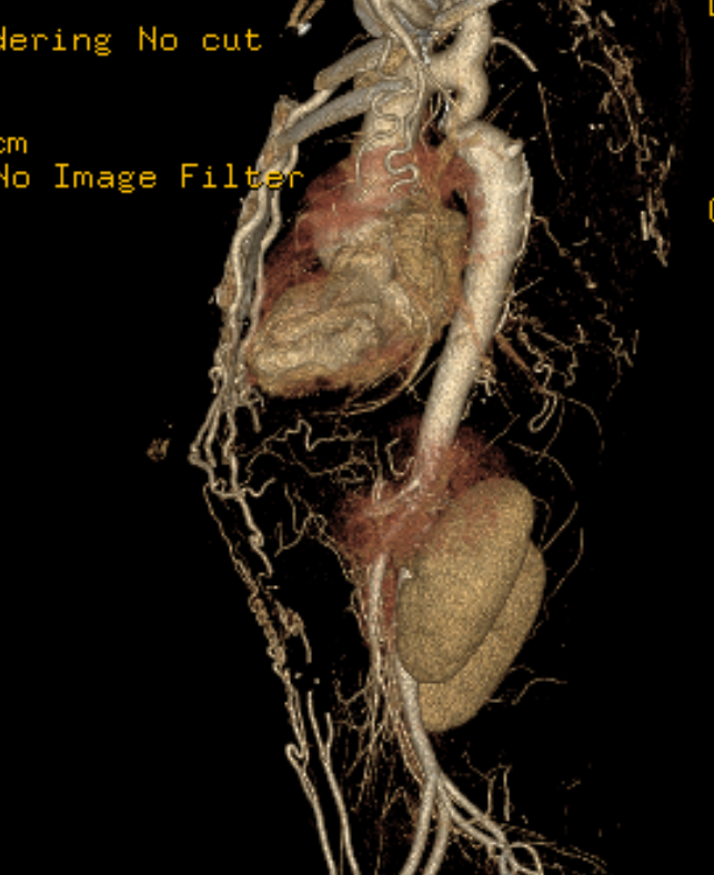 Aortic Coartation