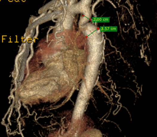 Aortic Coartation